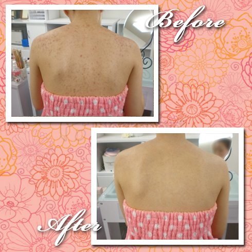 ニキビを隠す ニキビを隠す