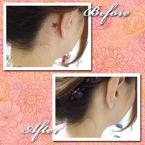 タトゥーを消す タトゥーを消す